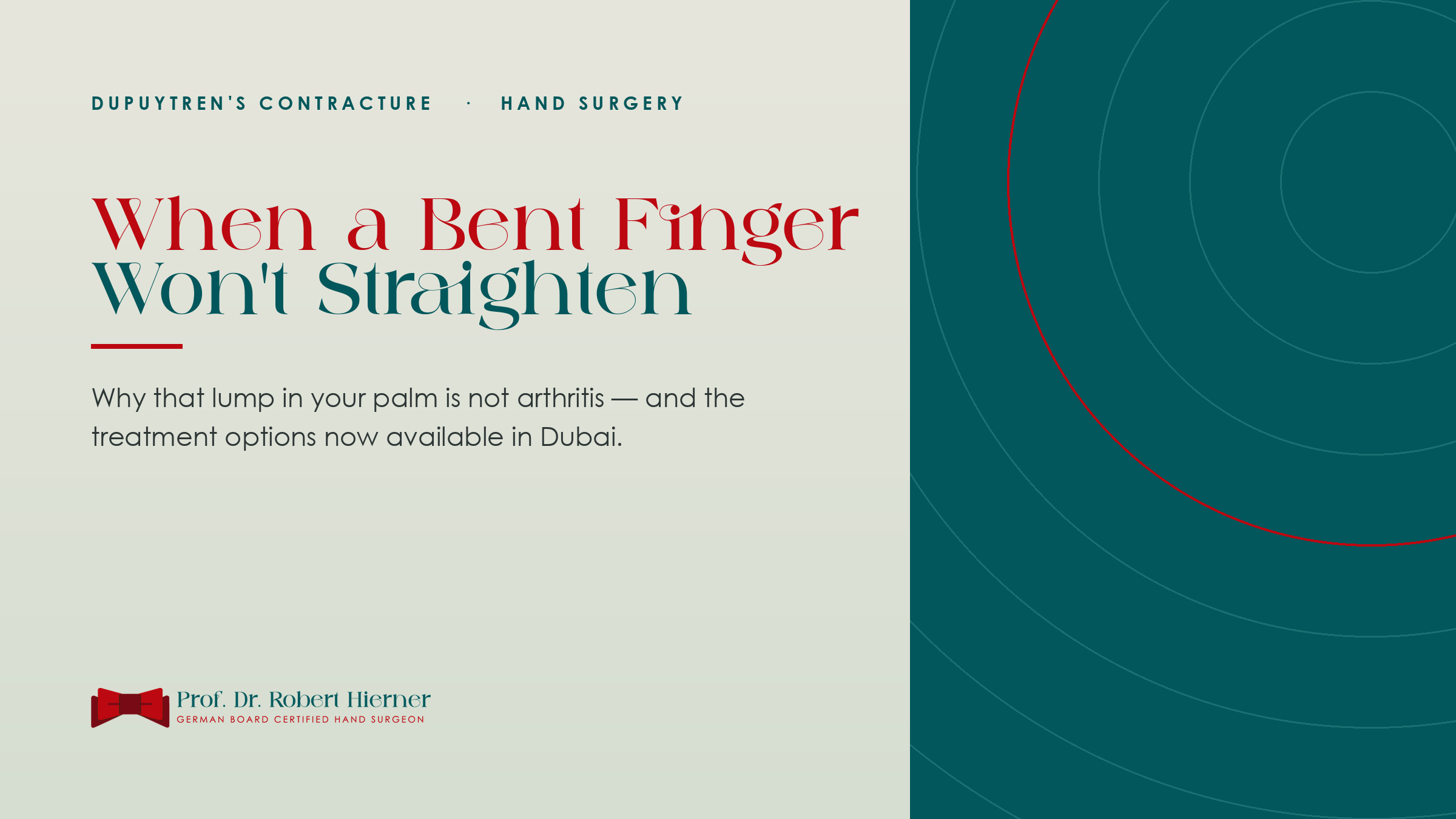 Dupuytren's Contracture: Why a Finger Won't Straighten — and How It's Treated in Dubai
